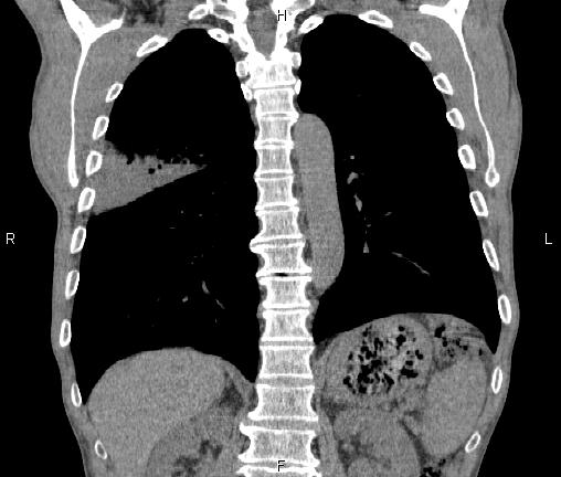 Air bronchogram in pneumonia (Radiopaedia 85719-101512 Coronal non-contrast 40).jpg