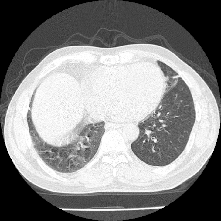 Airway foreign body in adult (Radiopaedia 85907-101779 Axial lung window 132).jpg