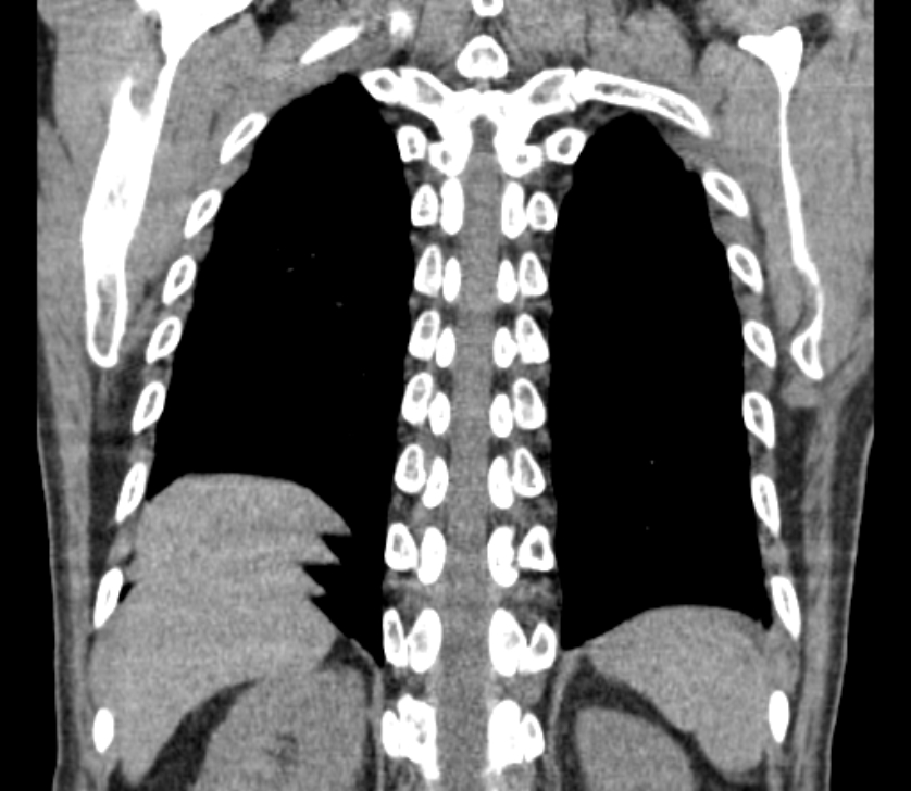 Airway foreign body in adult (Radiopaedia 85907-101779 Coronal liver window 225).jpg