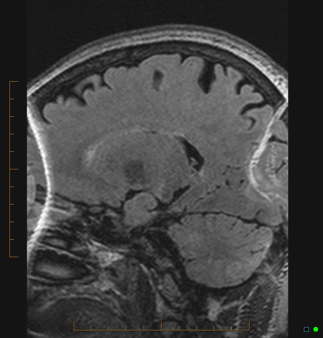 Aliasing artifact causing a spurious cerebellar lesion (Radiopaedia 48783-53810 Sagittal FLAIR 72).jpg