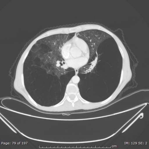 Alpha-1-antitrypsin deficiency (Radiopaedia 50561-55987 Axial lung window 34).jpg