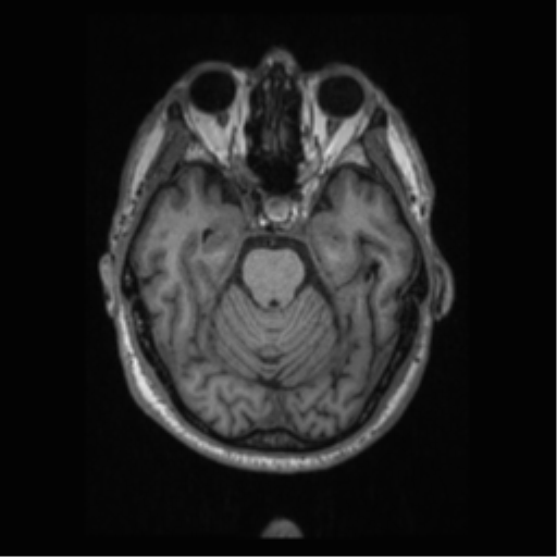 Alzheimer disease - probable (Radiopaedia 35334-36837 Axial T1 29).png