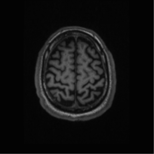 Alzheimer disease - probable (Radiopaedia 35334-36837 Axial T1 62).png