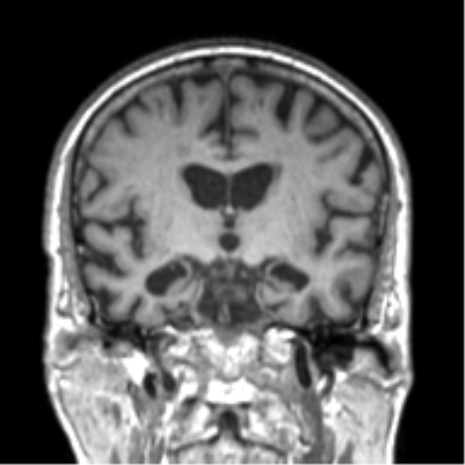File:Alzheimer disease and cerebral amyloid angiopathy (Radiopaedia 64234-73011 Coronal T1 34).png