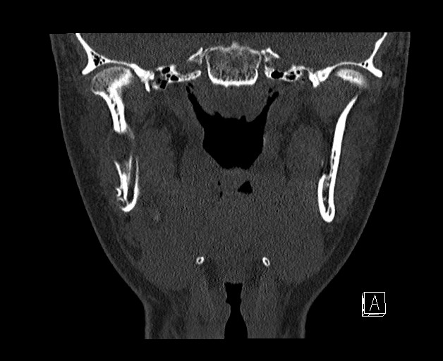 File:Ameloblastoma (Radiopaedia 26645-26793 bone window 19).jpg
