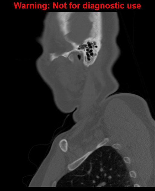 Ameloblastoma (Radiopaedia 33126-34164 Sagittal bone window 61).jpg