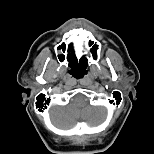 Ameloblastoma (Radiopaedia 38520-40623 Axial non-contrast 19).png