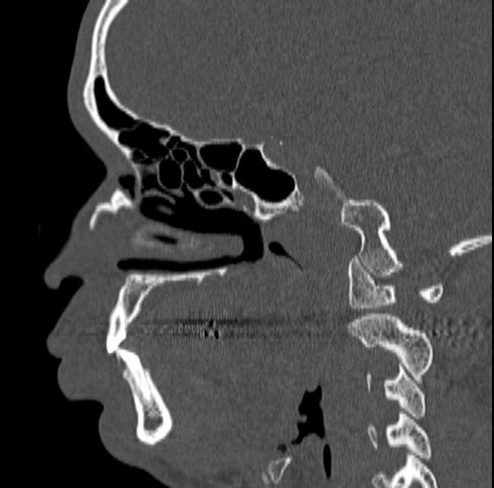 Ameloblastoma (Radiopaedia 77750-89997 Sagittal bone window 1).jpg