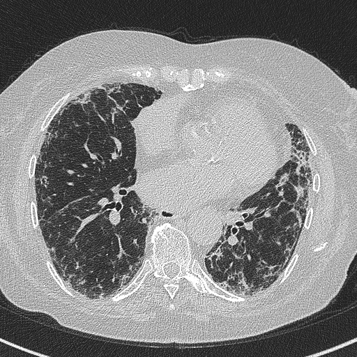 File:Amiodarone-induced pulmonary fibrosis (Radiopaedia 82355-96460 Axial lung window 42).jpg