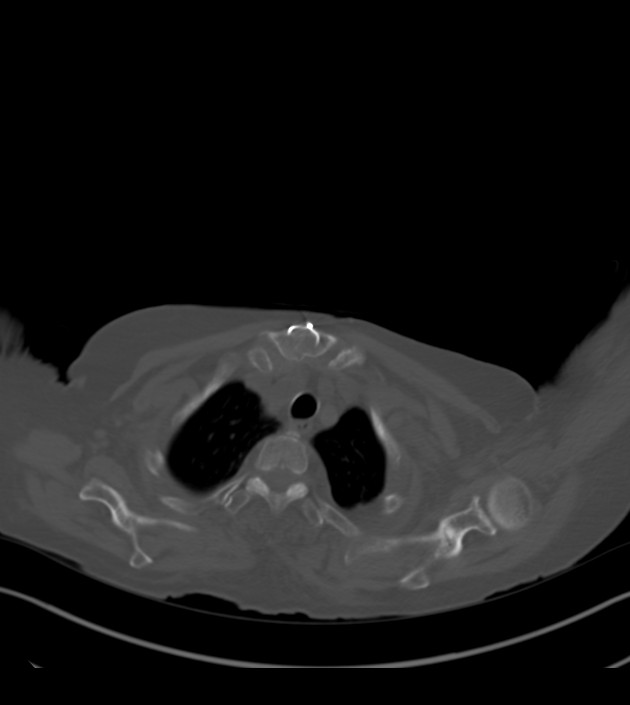 Amiodarone deposition in the liver (Radiopaedia 77587-89780 Axial bone window 12).jpg