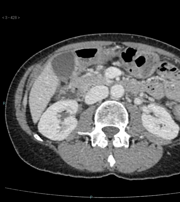 Ampulla of Vater metastasis (Radiopaedia 27820-28065 A 32).jpg