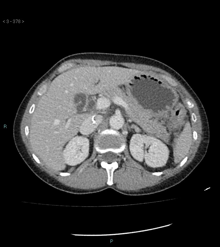 Ampulla of Vater metastasis (Radiopaedia 27820-28069 A 16).jpg