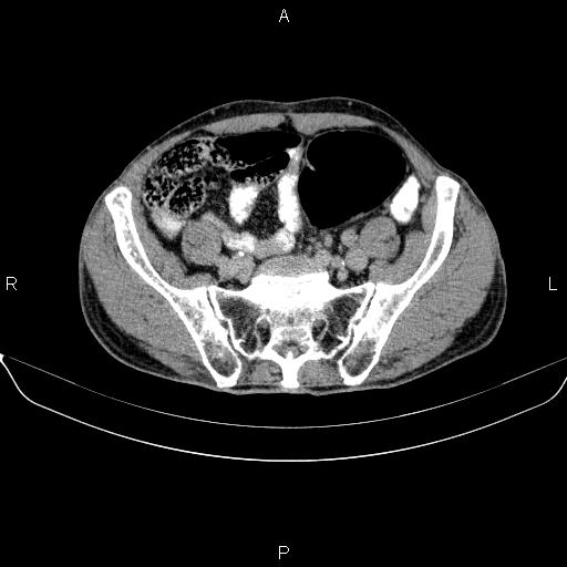 Ampullary adenocarcinoma (Radiopaedia 86093-102032 Axial C+ delayed 81).jpg