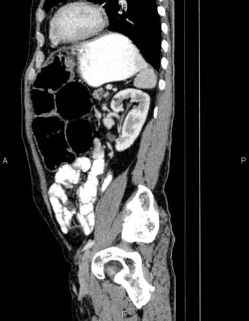 Ampullary adenocarcinoma (Radiopaedia 86093-102032 D 69).jpg