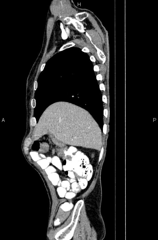 Ampullary adenocarcinoma (Radiopaedia 86093-102033 E 15).jpg
