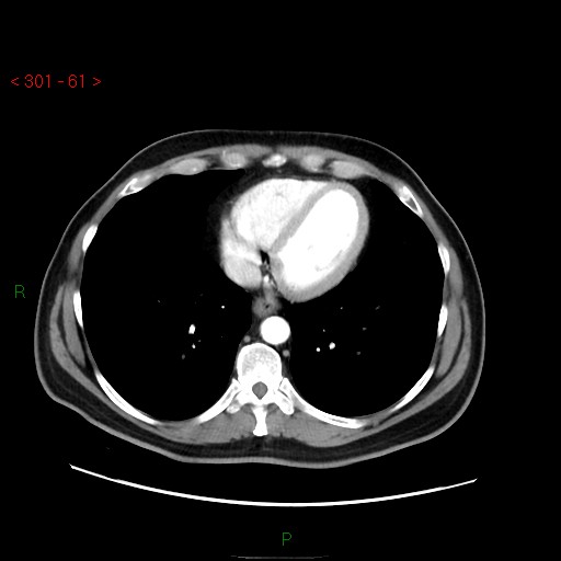 Ampullary carcinoma (Radiopaedia 56396-63056 B 7).jpg