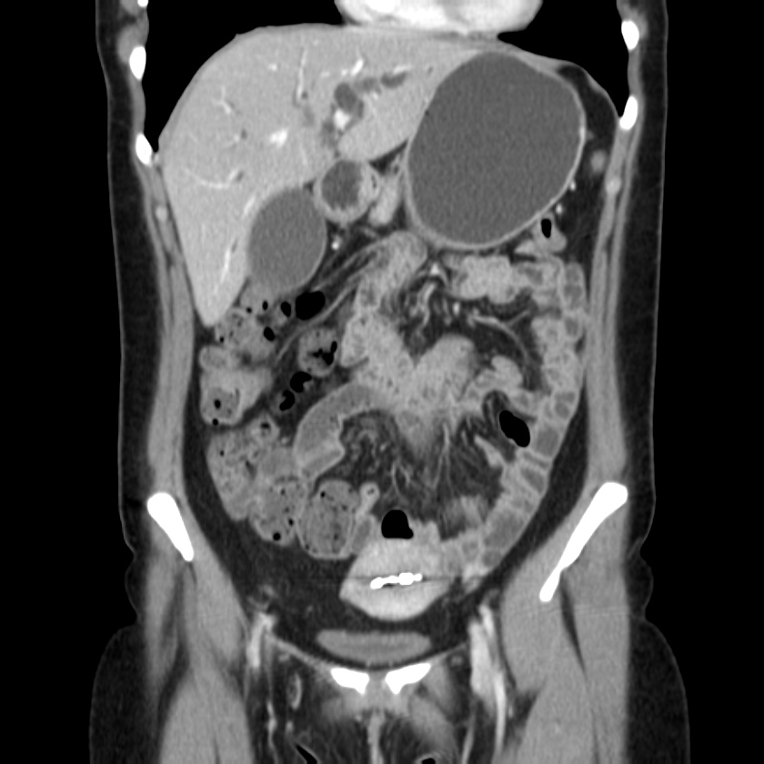 Ampullary tumor (Radiopaedia 22787-22816 E 20).jpg