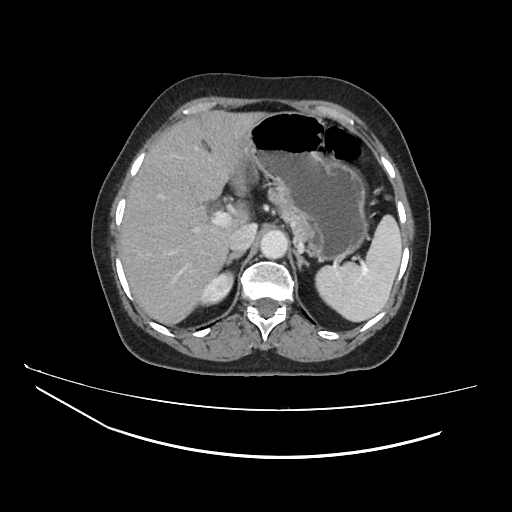 File:Ampullary tumor (Radiopaedia 60333-67998 A 18).jpg