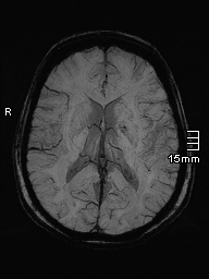 File:Amyotrophic lateral sclerosis (Radiopaedia 70821-81017 Axial SWI minIP 26).jpg