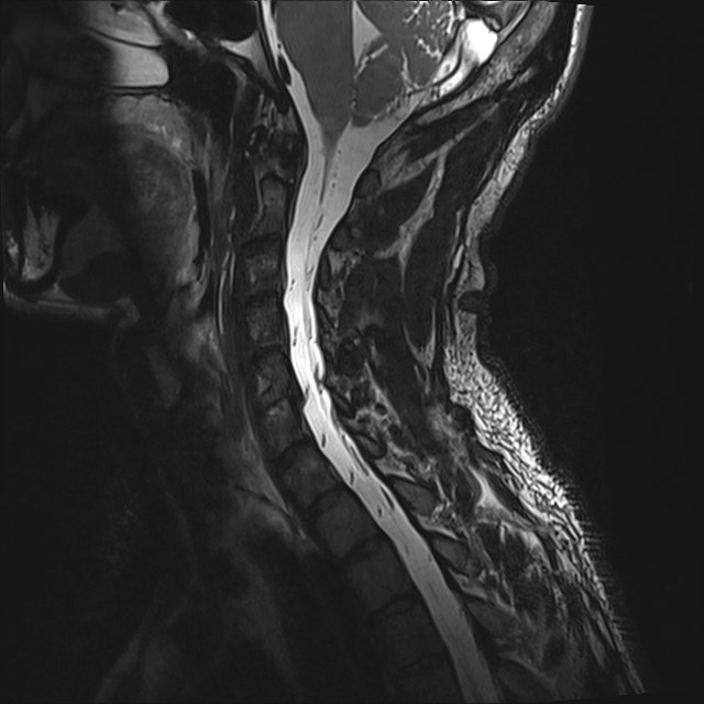 Amyotrophic lateral sclerosis (Radiopaedia 87352-103658 I 21).jpg