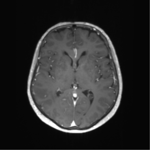 File:Anaplastic astrocytoma (Radiopaedia 86943-103160 Axial T1 C+ 29).png