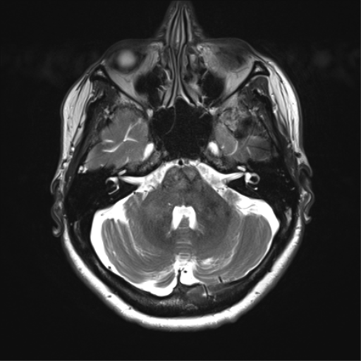 File:Anaplastic astrocytoma - thalamic glioma (Radiopaedia 59709-67115 Axial T2 10).png