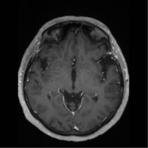 File:Anaplastic astrocytoma IDH wild-type (pseudoprogression) (Radiopaedia 42209-45276 Axial T1 C+ 70).png