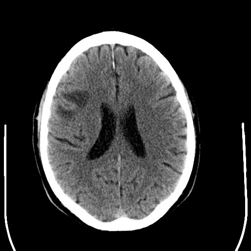 File:Anaplastic meningioma with recurrence (Radiopaedia 34452-35781 Axial non-contrast 21).png