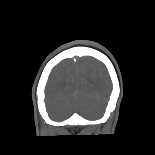 Aneursym related subarachnoid hemorrhage with hydrocephalus (Radiopaedia 45105-49084 B 71).jpg