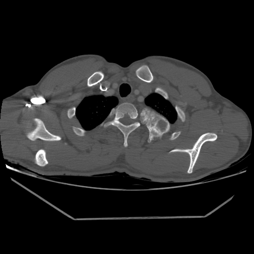 Aneurysmal bone cyst - rib (Radiopaedia 82167-96220 Axial bone window 55).jpg