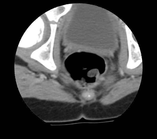 File:Aneurysmal bone cyst - sacrum (Radiopaedia 65190-74195 Axial non-contrast 47).jpg