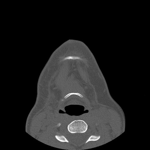 Aneurysmal bone cyst of the mandible (Radiopaedia 43280-46823 Axial bone window 3).jpg
