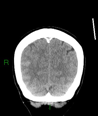 File:Aneurysmal subarachnoid hemorrhage with intra-axial extension (Radiopaedia 84371-99699 Coronal non-contrast 16).jpg
