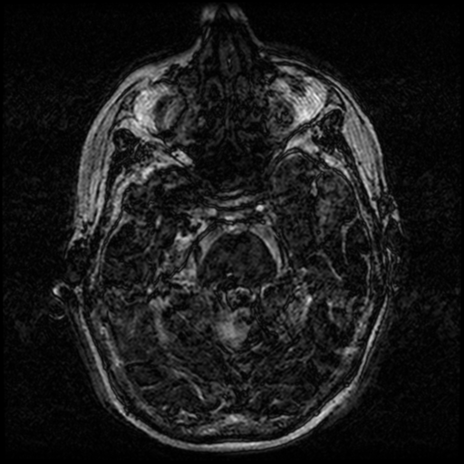 Angioinvasive aspergillosis in the pituitary fossa (Radiopaedia 39676-42010 Ax 3D FIESTA VOLUME 34).png
