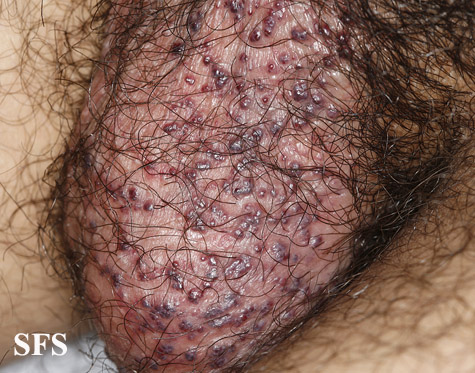 Angiokeratoma Of The Scrotum (Dermatology Atlas 9).jpg