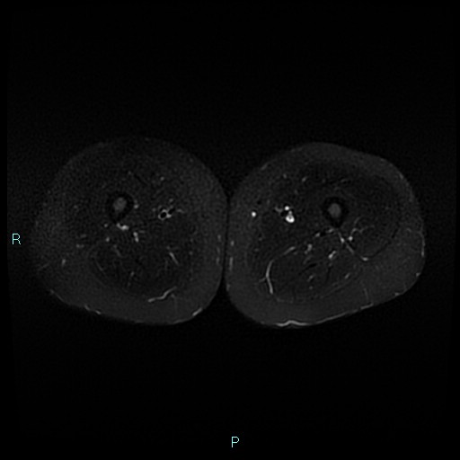 Angioleiomyoma (Radiopaedia 85442-101078 Axial STIR 49).jpg