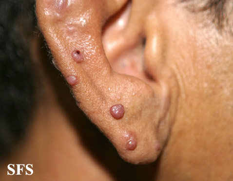 Angiolymphoid Hyperplasia With Eosinophilia (Dermatology Atlas 9).jpg