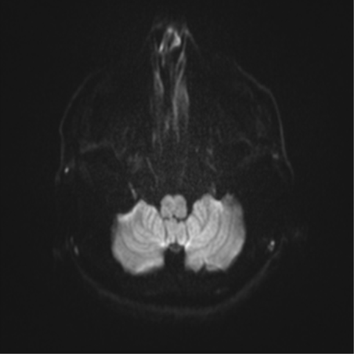 Angular epidermoid cyst (Radiopaedia 46908-51438 Axial DWI 74).png