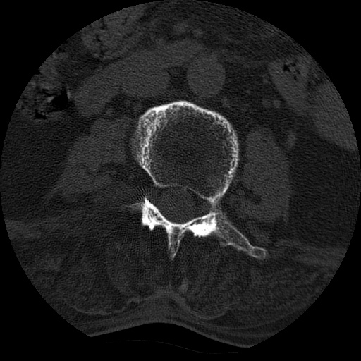 Ankylosing spondylitis complicated by fracture-dislocation (Radiopaedia 33583-34674 Axial non-contrast 76).jpg