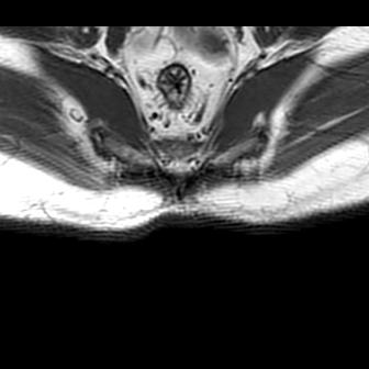 File:Ankylosing spondylitis with zygapophyseal arthritis (Radiopaedia 38433-40517 B 15).jpg