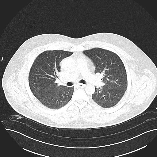 File:Anomalous origin of the left coronary artery with malignant course (Radiopaedia 77842-90126 Axial lung window 15).jpeg