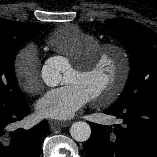 File:Anomalous origin of the left coronary artery with malignant course (Radiopaedia 77842-90126 C 110).jpeg