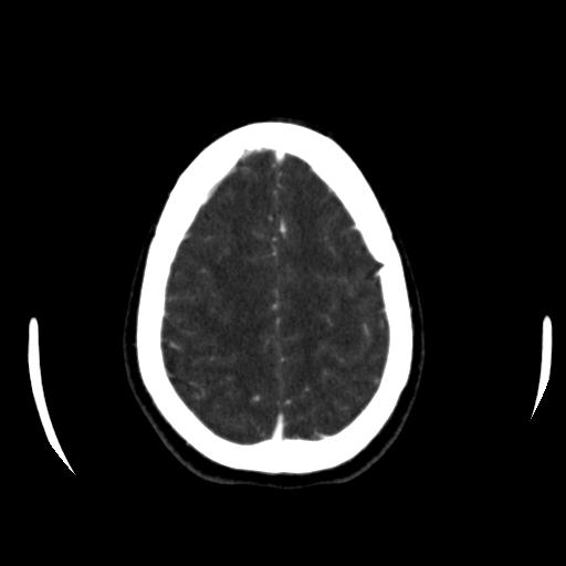 File:Anterior communicating artery aneurysm (Radiopaedia 16633-16335 A 37).jpg