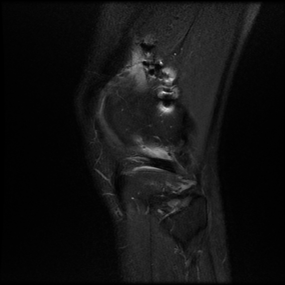 File:Anterior cruciate ligament graft tear and bucket-handle tear of medial meniscus (Radiopaedia 75867-87254 Sagittal PD fat sat 25).jpg