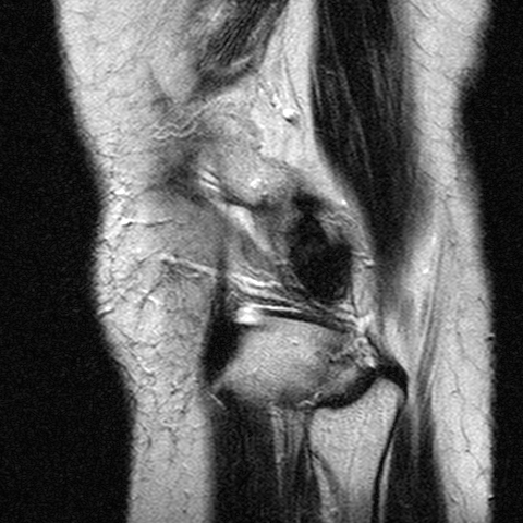 File:Anterior cruciate ligament mucoid degeneration (Radiopaedia 60853-68633 Sagittal T2 24).jpg