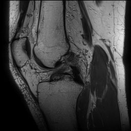 Anterior cruciate ligament rupture with Segond fracture (Radiopaedia 69043-78806 Sagittal PD 94).jpg