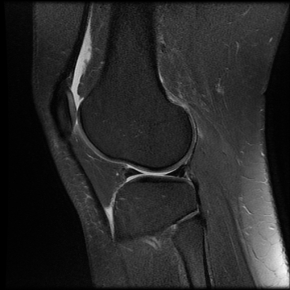 File:Anterior cruciate ligament tear, Wrisberg rip and bucket-handle tear of medial meniscus (Radiopaedia 75872-87266 Sagittal PD fat sat 7).jpg
