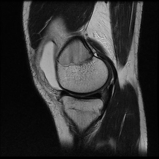 File:Anterior cruciate ligament tear (Radiopaedia 61500-69462 Sagittal T2 5).jpg