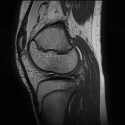 Anterior cruciate ligament tear - pediatric (Radiopaedia 62152-70260 Sagittal PD 120).jpg