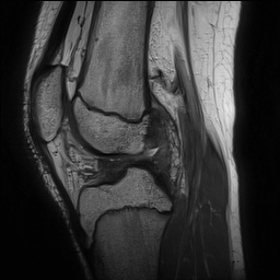 File:Anterior cruciate ligament tear - pediatric (Radiopaedia 62152-70260 Sagittal PD 97).jpg